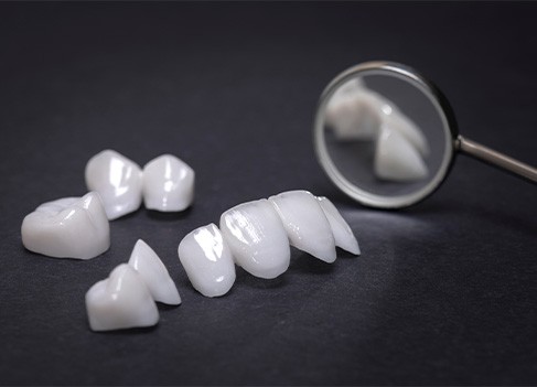 Example of veneers
