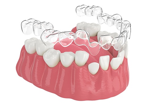 Illustration of clear aligner being placed on crooked teeth