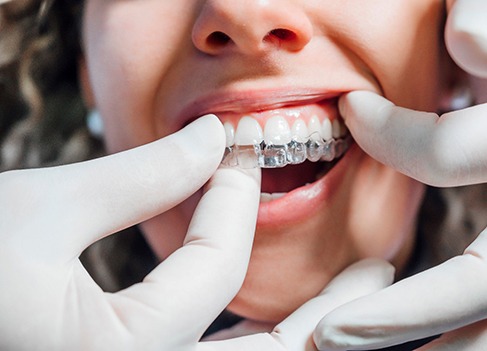 Orthodontist placing clear aligner on patient's top teeth